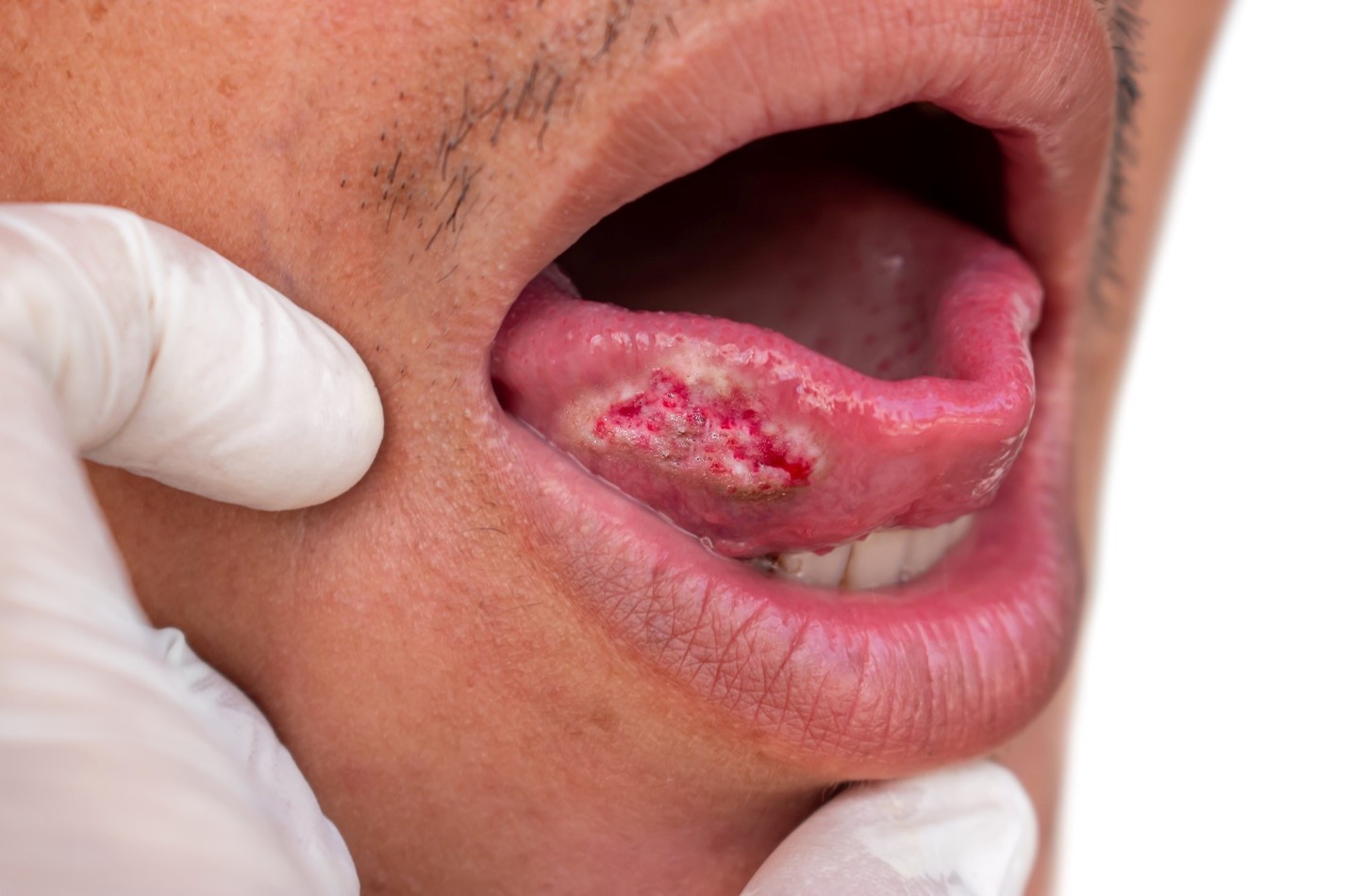 Oral cancer: A multicenter study